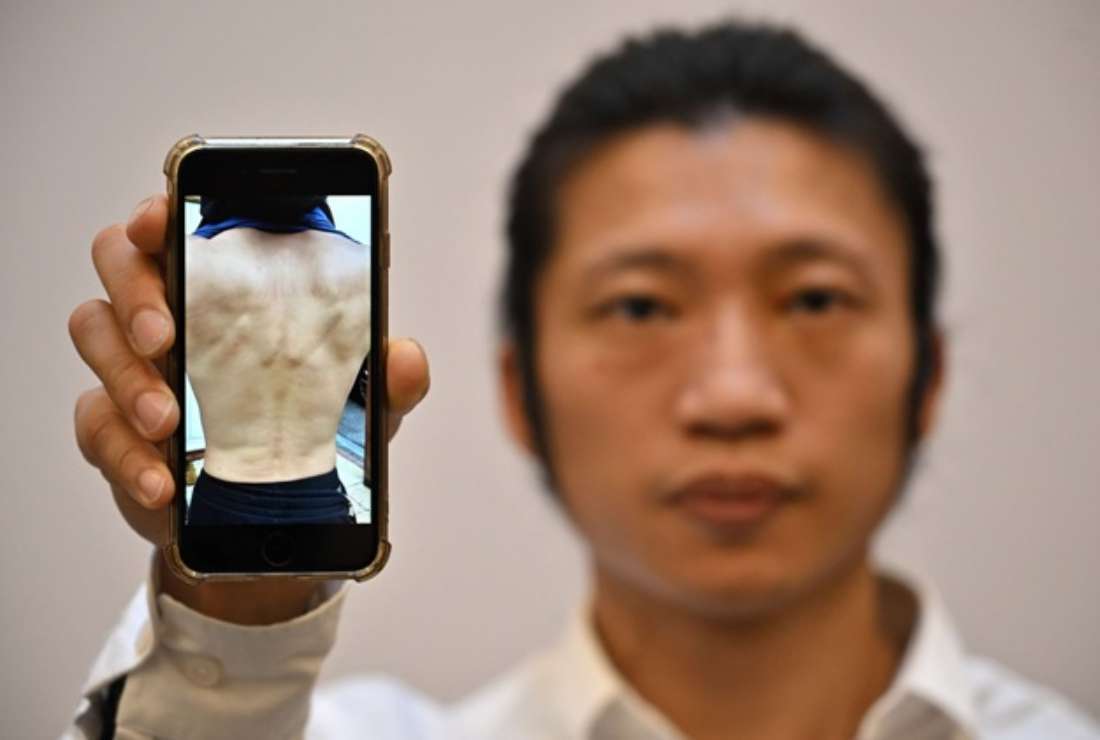 Hong Kong pro-democracy protester Bob Chan poses with a picture on his phone showing injuries following the assault at China's Manchester consulate during a demonstration three days earlier, during a press conference, in London, on Oct. 19